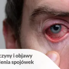 Silnie zaczerwienione oko z widocznymi naczynkami, objaw ropnego zapalenia spojówek.