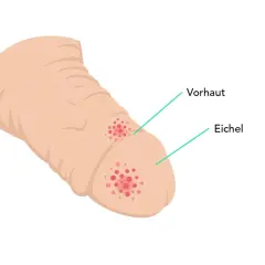 Illustration zeigt einen Penis mit roten Flecken auf der Eichel und Vorhaut, die auf einen möglichen tumor am penis hinweisen könnten.