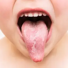 Widoczne krostki na języku u dziecka, które mogą świadczyć o infekcji lub alergii.