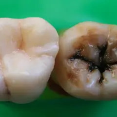 Un diente sano junto a otro con caries avanzadas, oscuras y profundas. Las caries duelen y arruinan la sonrisa.
