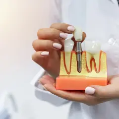 Model szczęki z implantem i koroną. Pokazuje, jak wygląda sinus lift otwarty, przygotowujący do wszczepienia implantu.