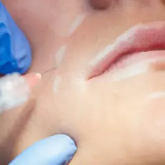 Nahaufnahme einer Injektion mit Hyaluron für die Gesichtspflege. Blaue Handschuhe halten eine Spritze, die eine feine Nadel in die Haut einführt.