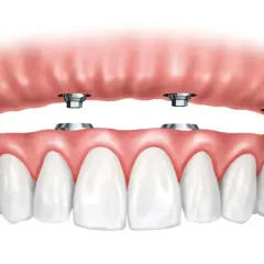 Arcata dentale superiore con impianti dentali. La protesi superiore si aggancia a quattro pilastri metallici.