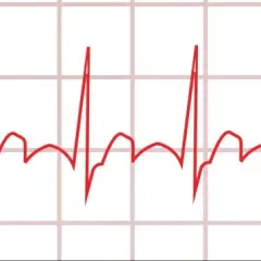 Myokarditis Diagnostik EKG: EKG-Befunde verstehen und richtig deuten
