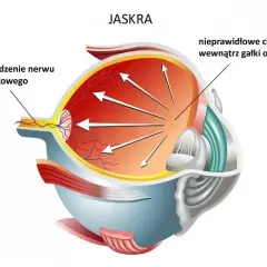 Czy jaskra jest wyleczalna? Odkryj prawdę o leczeniu tej choroby