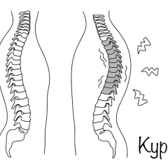 Confronto tra colonna vertebrale sana e cifosi. La cifosi causa posture curve, rendendo le persone gobbe.