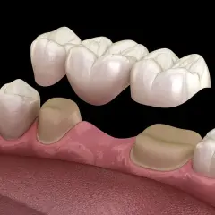 Un ponte dentale che sostituisce un dente mancante, ancorato a corone su denti adiacenti.