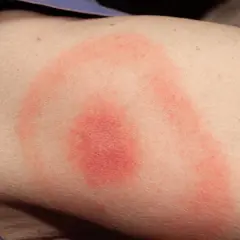 Erupción circular roja en la piel, indicativa de una picadura de garrapata en un humano.