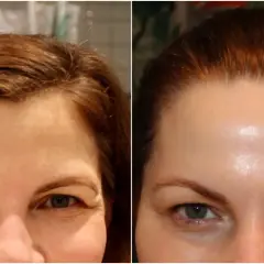 Före- och efterbilder visar hur man kan få bort bekymmersrynka utan botox. Pannan ser slätare ut på efterbilden.