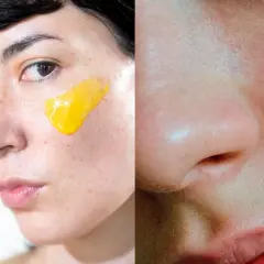 Nära bild på ansikte med gul kräm på kinden, möjligen för att behandla rosacea. Retinol kan vara en del av behandlingen.