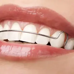 Uśmiech z metalowym drutem aparatu ortodontycznego, który utrzymuje zęby w idealnym położeniu. To jest **retainer stały**.