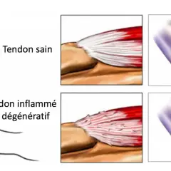 Comparaison d'un tendon sain et d'un tendon inflammé, montrant les fibres déchirées typiques du tennis elbow.