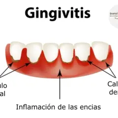 Encías inflamadas y con sarro, indicando gingivitis grave. Se observa cálculo dental y la inflamación de las encías.