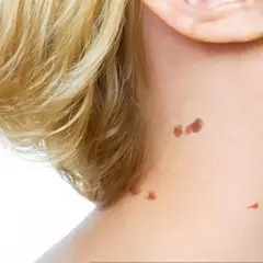Plusieurs petites excroissances cutanées, semblables à des acrochordons, sont visibles sur le cou d'une personne.