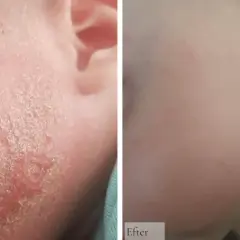Före och efter-bilder som visar ett barns ansikte med svårt eksem bebis, som sedan läkt och blivit mjuk och fin.