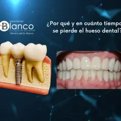 Modelo de implante dental y encías sanas. La imagen aborda la **pérdida hueso dental** y su tiempo.