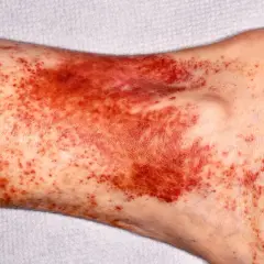 Piel con manchas oscuras y rojizas en la zona del tobillo y la parte baja de la pierna, indicando posibles hematomas o petequias.