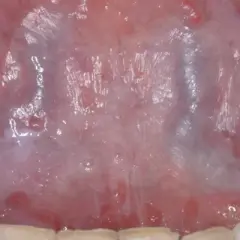 Vista detallada de la lengua mostrando áreas blanquecinas y rojizas, indicativas de leucoplasia en la lengua.