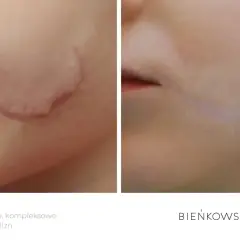 Przed i po laserowym usuwaniu blizn na twarzy. Widoczna znacząca poprawa wyglądu skóry.