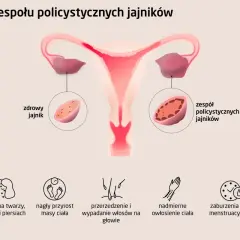 Zaburzenia hormonalne jajników: objawy, diagnoza i pomoc