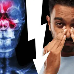 Radiografia del cranio che mostra l'anatomia del seno mascellare infiammato, accanto a un uomo che si tocca il naso per il dolore.