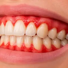 Gengive rosse e gonfie attorno ai denti bianchi. Scopri cosa fare per gengive infiammate e ritrovare un sorriso sano.