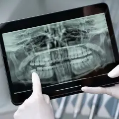 Dentysta analizuje RTG szczęki na tablecie, wskazując na ósemki. Decyzja, w jakim odstępie można wyrywać ósemki, zależy od ich położenia.