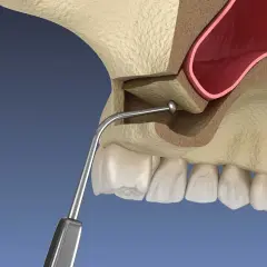Ilustración de elevación de seno maxilar, mostrando el instrumento dental y la anatomía ósea.