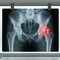 RTG miednicy z zaznaczonym prawym stawem biodrowym, wskazującym na bolące biodra.