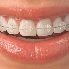Sonrisa con brackets transparentes, mostrando dientes que necesitan brackets para alinearse y lucir perfectos.