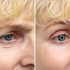 Przed i po zabiegu blefaroplastyki. Widoczne wygładzenie skóry wokół oka, redukcja zmarszczek i opadającej powieki.