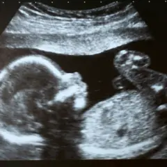 Ultraschallbild eines Babys. Die detaillierte Aufnahme zeigt das Gesicht und den Körper des Kindes, was beim Ultraschall zur Geschlechtsbestimmung hilfreich ist.