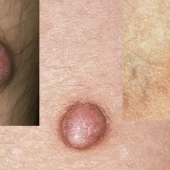 Nahaufnahme von Hautveränderungen, die auf fibrose Hautbilder hinweisen. Kleine, erhabene Knötchen auf der Haut.