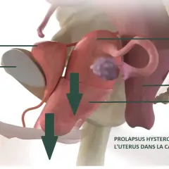 Illustration anatomique montrant le prolapsus utérin, une descente de l'utérus causant une fatigue pelvienne. La vessie et le rectum sont aussi visibles.