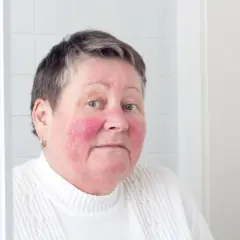 Kvinna med rodnad i ansiktet, troligen rosacea på kroppen.