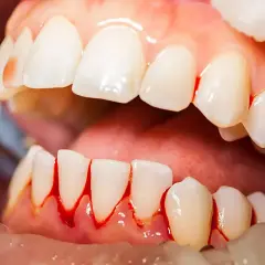 Encias inflamadas con sangrado alrededor de los dientes. Se observa un instrumento dental.