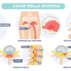 Illustrazione delle cause della sciatica: sindrome del piriforme, discopatia degenerativa, stenosi spinale ed ernia del disco che comprimono il nervo sciatico.