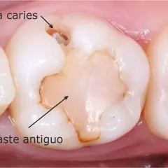 Diente con empaste antiguo y nueva caries. El empaste ha cedido, dejando espacio para la caries.