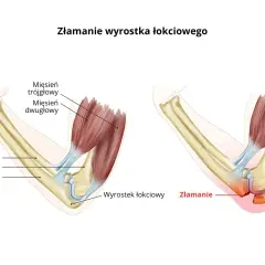 Ilustracja pokazuje złamanie wyrostka łokciowego, z zaznaczoną opuchlizną i miejscem złamania.