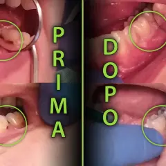 Prima e dopo il trattamento di una carie al colletto dentale. La carie è visibile in verde.