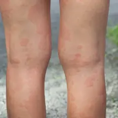 Widoczne czerwone, swędzące plamy na nogach, które mogą być objawem alergii lub pokrzywki.