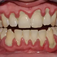 Gengive infiammate e retratte, con accumuli giallastri alla base dei denti, mostrano perché vengono le placche e i problemi che causano.