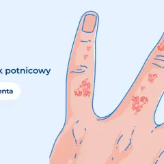 Dłoń z wypryskiem potnicowym. Czy egzema jest wyleczalna? UPacjenta.