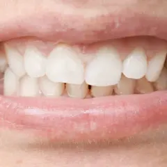 Primer plano de una boca con dientes blancos y labios rosados. Se observa una mordida profunda, donde los dientes superiores cubren significativamente los inferiores.