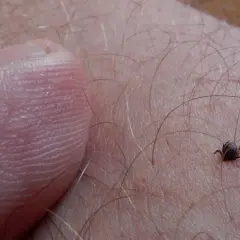 Mały kleszcz na skórze, obok palca. Może to być początek gorączki po ugryzieniu kleszcza.