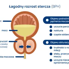 Ilustracja przedstawia łagodny rozrost stercza, gdzie powiększony gruczoł uciska cewkę moczową, wpływając na jej wymiary i funkcje.