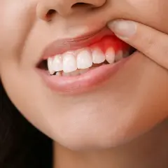 Dito indice indica un'infiammazione gengive, con arrossamento e gonfiore visibili attorno ai denti.