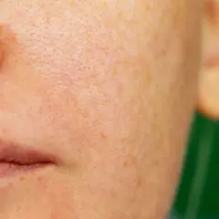 Närbild på en persons ansikte med synliga porer och pigmentfläckar, som visar effekterna av melasma behandling.