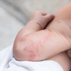 Brazos de un bebé con urticaria, mostrando ronchas rojas y elevadas.