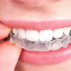 Una persona se ajusta un alineador transparente. Aunque el tratamiento es discreto, a veces el **invisalign duele** al principio.